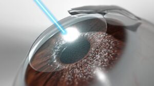 Read more about the article Tips on how to know the best Lasik eye surgeon