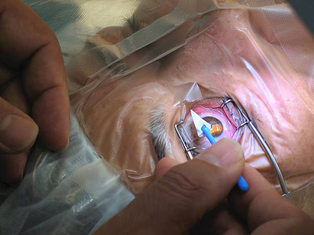 Best Pro Tips on How to Prepare for A Successful Cataract Surgery
