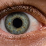Laser Eye Surgery